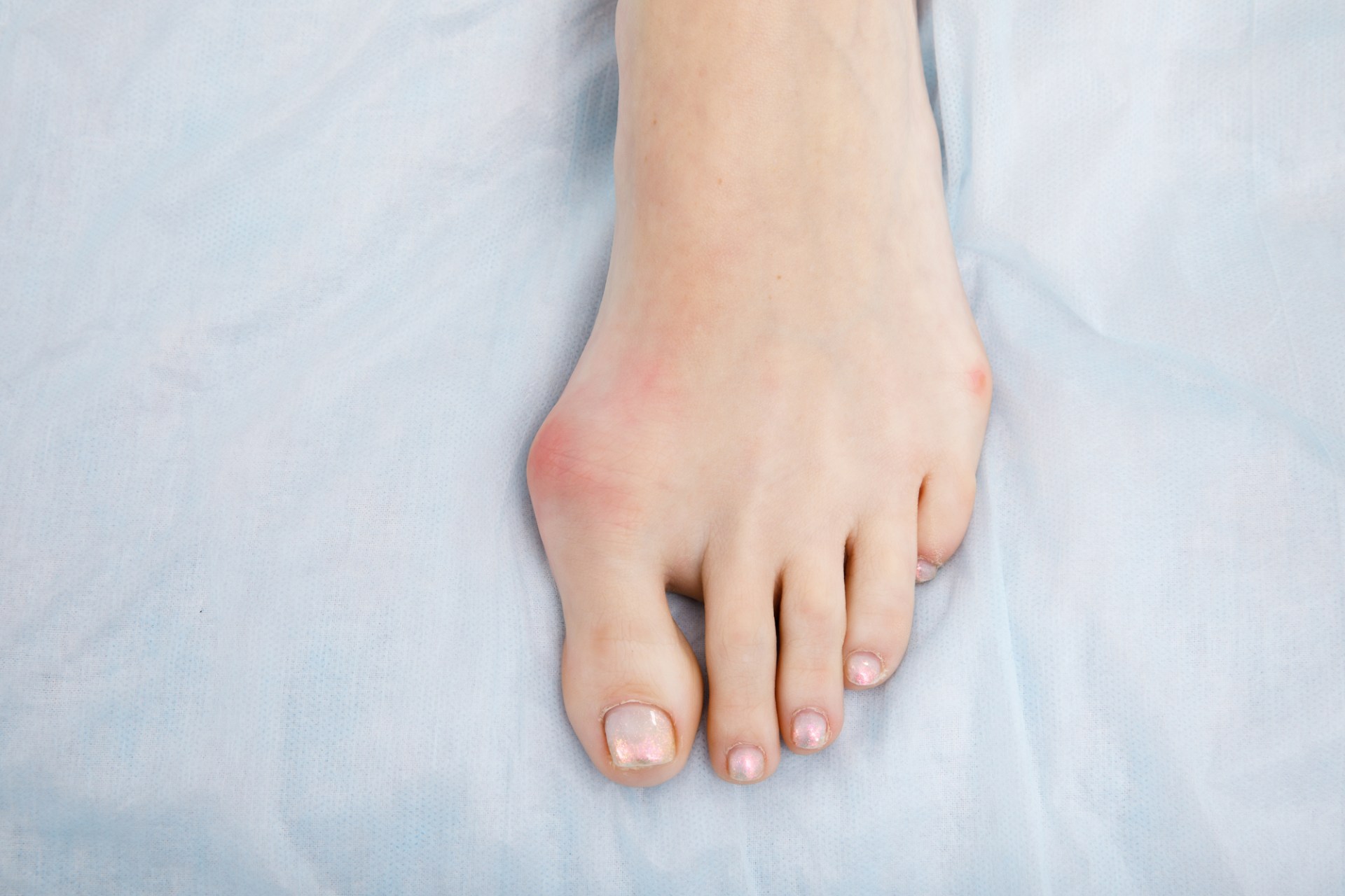 外反母趾による指の変形 | 愛知県藤が丘の接骨院ならもりや接骨院 藤が丘院